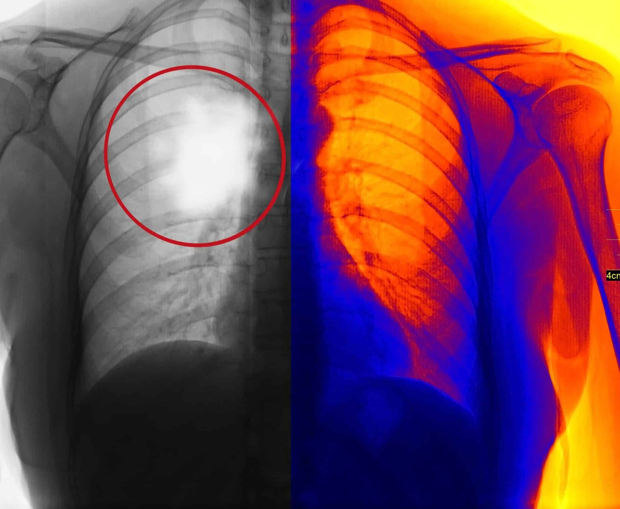 chest x ray copd diagnosis