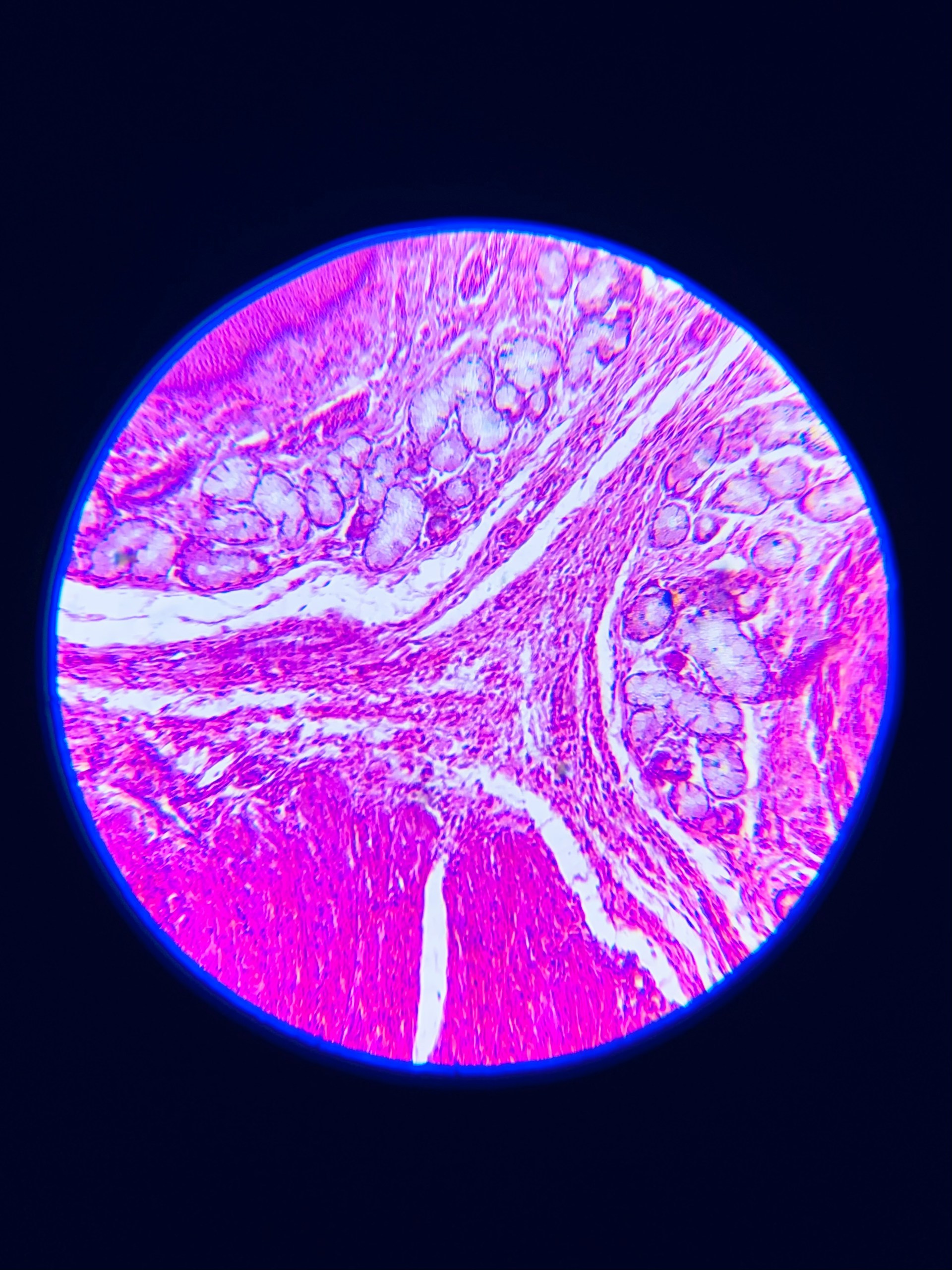 Microscopic view of epithelioid mesothelioma tissue sample showing uniform, clustered cancer cells stained in pink and purple