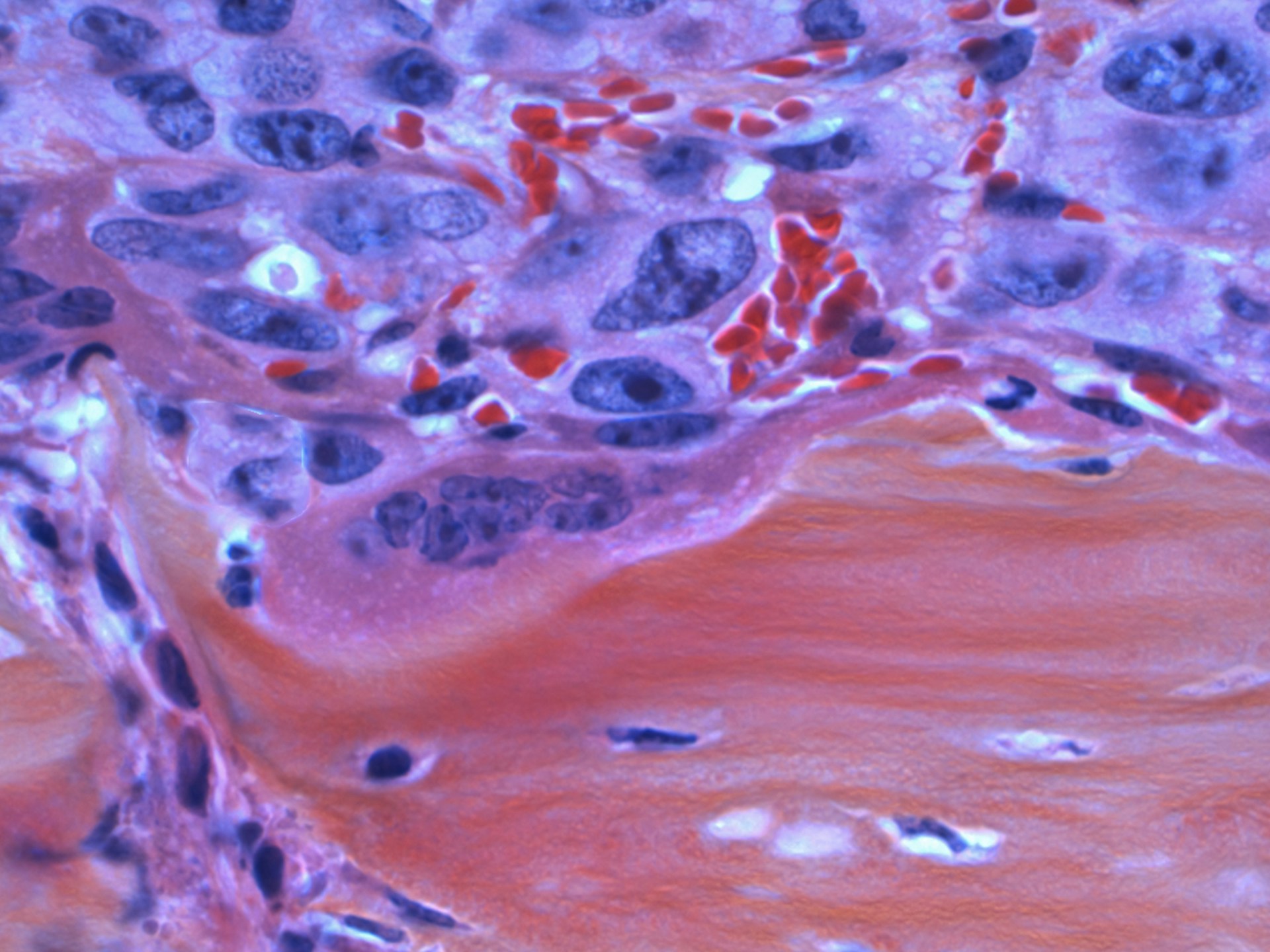 Microscopic image showing spindle-shaped tumor cells characteristic of Sarcomatoid Mesothelioma.