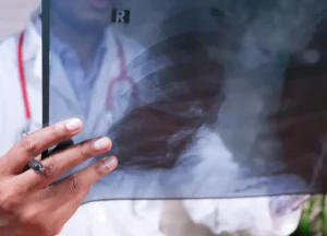 Physician pointing at X-rays and CT scans of lungs to explain diagnosis and treatment options for mesothelioma and asbestosis